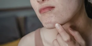 Natural remedies for acne-free skin