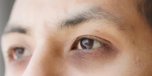 How to remove dark circles naturally fast