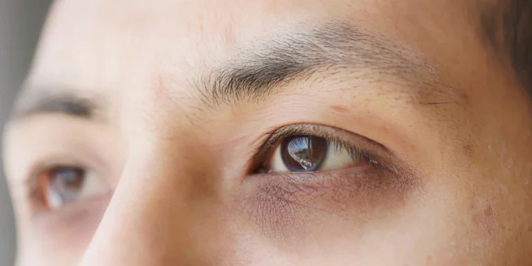 How to remove dark circles naturally fast