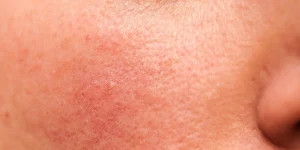 Natural ways to improve skin texture